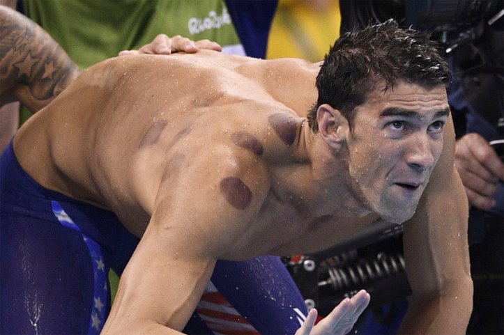 phelps-cupping-1200 (1)